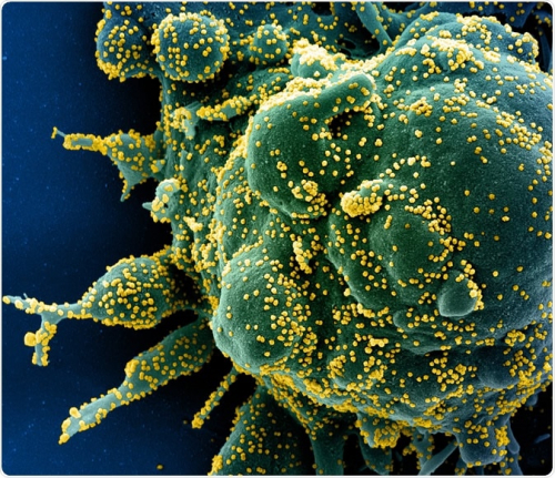Novel Coronavirus SARS-CoV-2 Colorized scanning electron micrograph of an apoptotic cell (green) heavily infected with SARS-COV-2 virus particles (yellow), isolated from a patient sample. Image captured at the NIAID Integrated Research Facility (IRF) in Fort Detrick, Maryland. Credit: NIAID