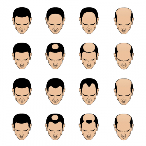 Experts on Male Pattern Baldness | Aventus Clinic